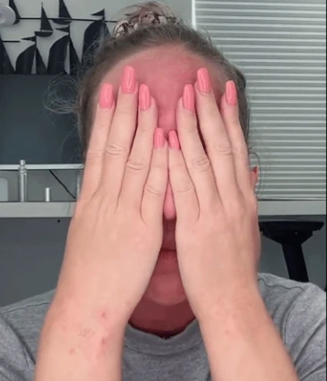 Woman Sobs After Covid Vaccine Injury Leaves Her with Horrific Facial Outbreaks