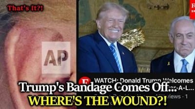 BIG REVEAL: Trump's Bandage Comes Off Showing... Minor Discoloration? Can The Gaslighting Stop Now? - Watch