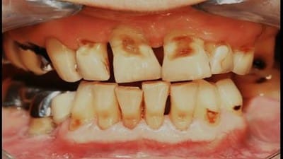 Extermination Shots - Correlation Between The Death Shot, Fluoride And Declining Oral Health - Watch