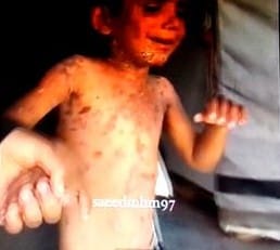 gaza-smallpox-258x231-72ppi-opt.jpg