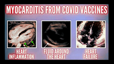 Myocarditis From COVID Vaccines